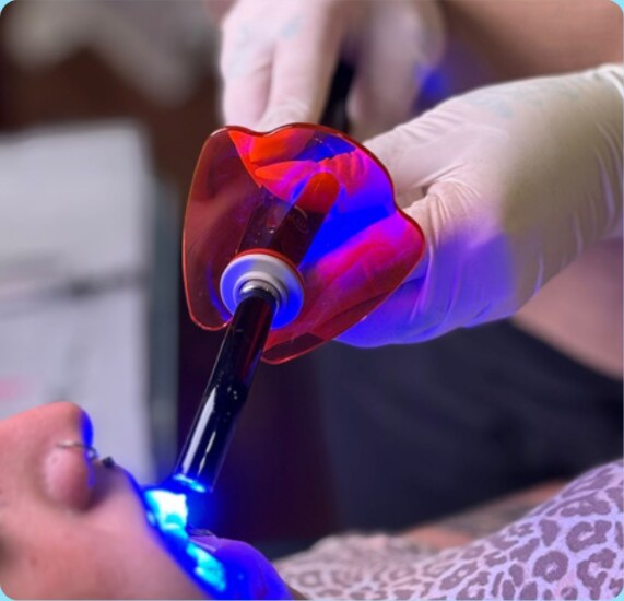 Aplicação de piercing dental com luz odontológica